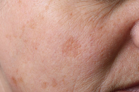 How to Treat Skin Impacted by Melasma