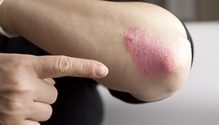 Pt 2: How to Treat Eczema on the Body