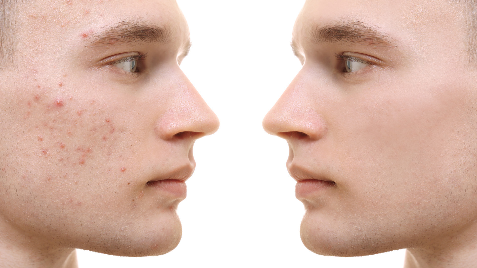 Targeting Types of Acne with the Right Ingredients