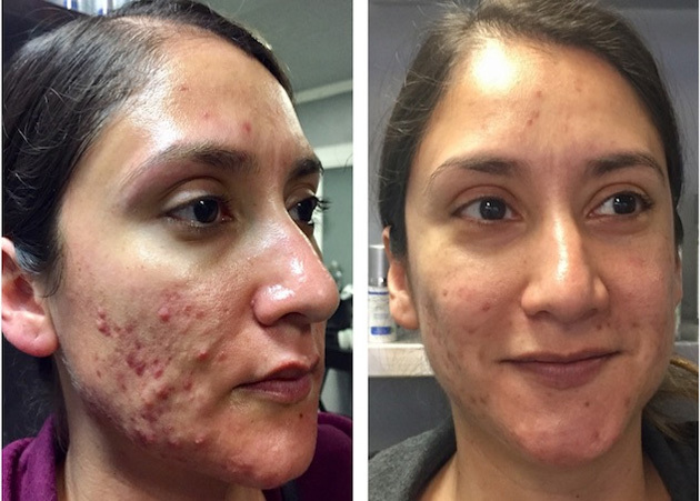 Acne Face-Off Finalist Before & After