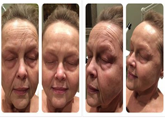 One Treatment Before & After- Uplift Facial