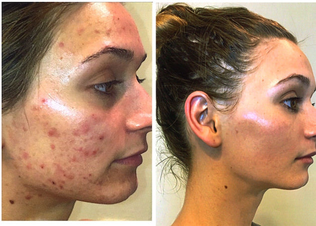 Acne Face-Off Finalist Before & Afters