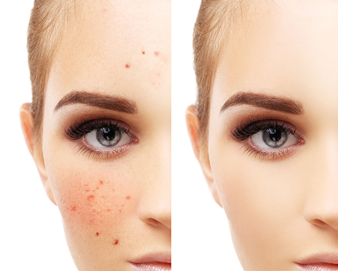 Why Focusing on Wound Healing is Key to Treating Acne