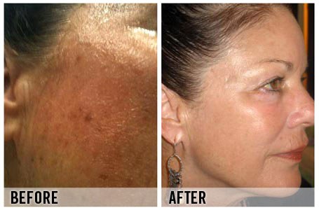 Melanin Lift Peel for Hyperpigmentation