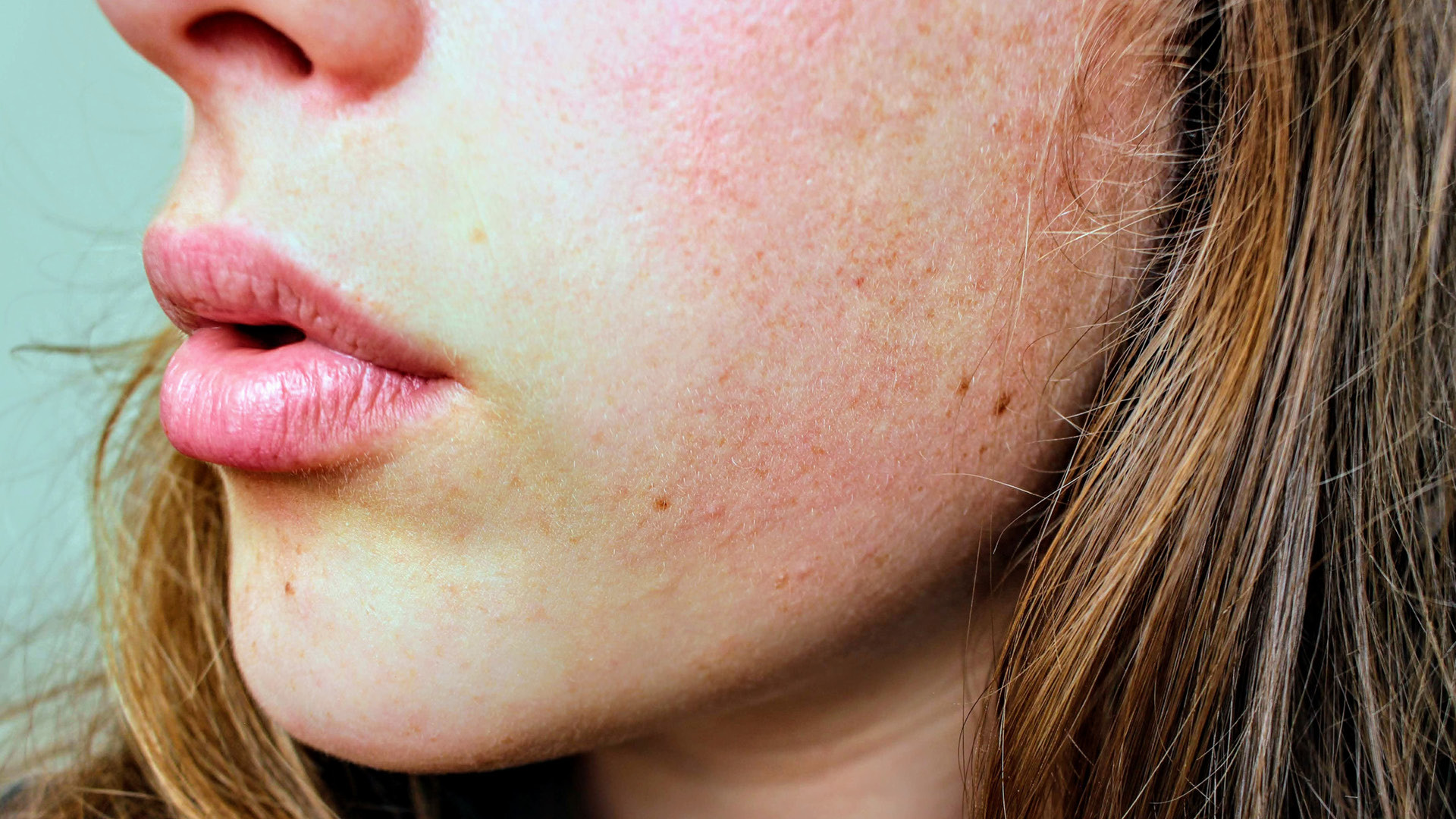 How to Restore and Protect Rosacea Skin