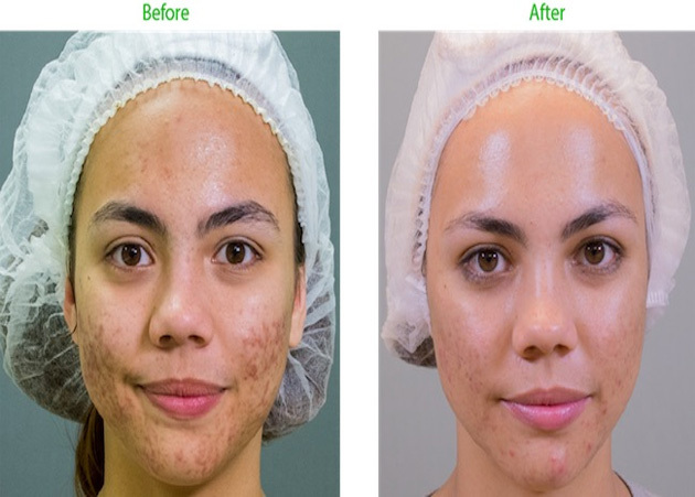 Acne Before & After-90 Day